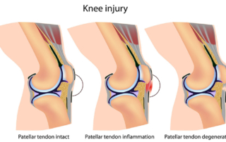 patellar tendonitis graphic for physical therapy