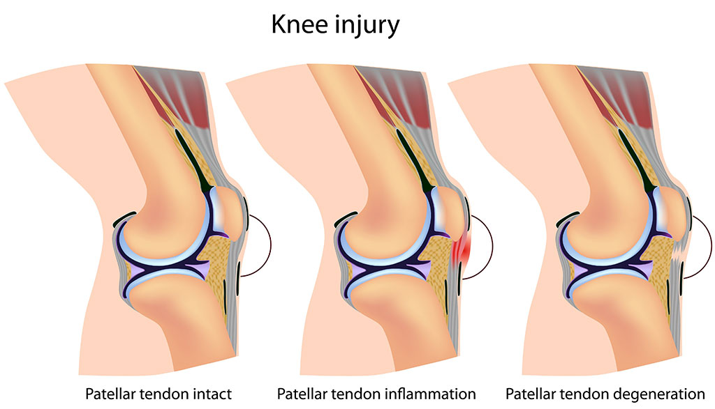 patellar tendonitis graphic for physical therapy graphic