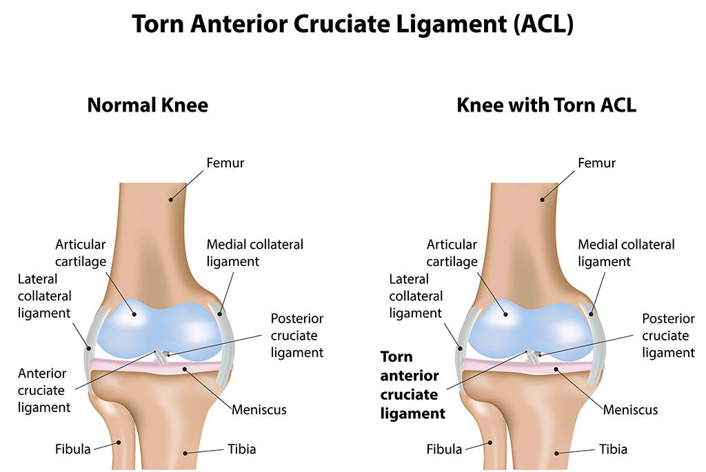 acl tear and physical therapy graphic
