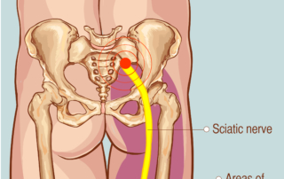 Physical therapy for sciatica infographic