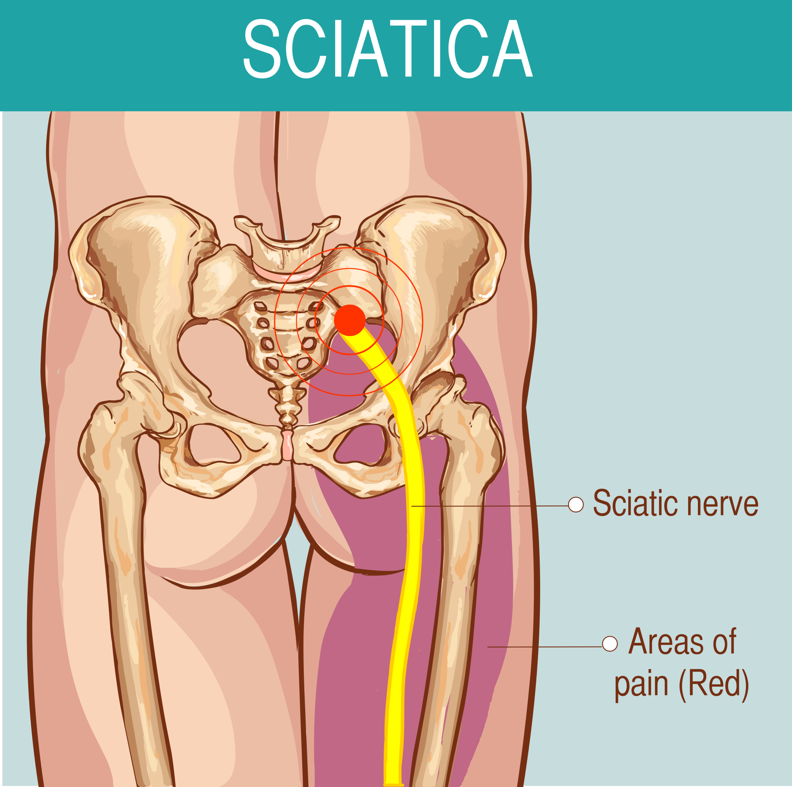 Physical therapy for sciatica infographic