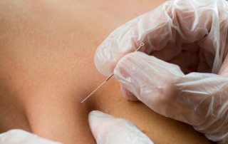 dry needling in physical therapy