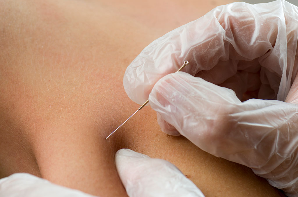 What Is Dry Needling And How Does It Work?